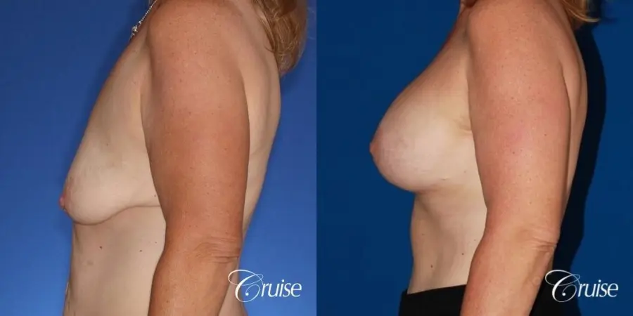 best anchor breast lift with specialist and plastic surgeon - Before and After 2