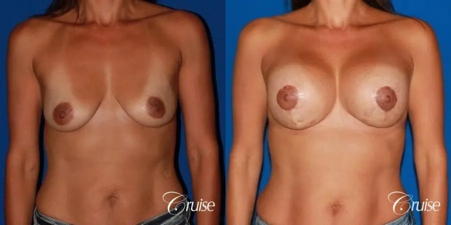best breast lift on 41 yr old with HP silicone - Before and After 1