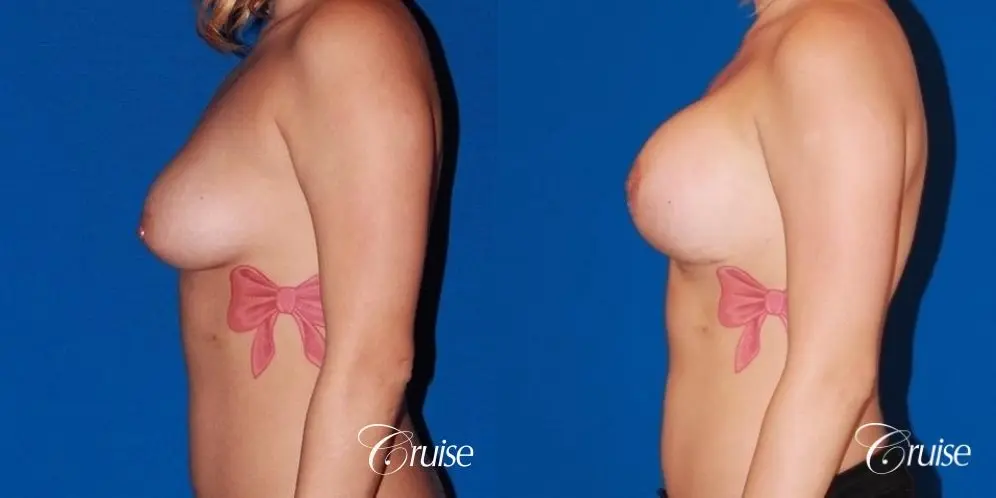 best breast lift scars on young girl with saline implants - Before and After 2
