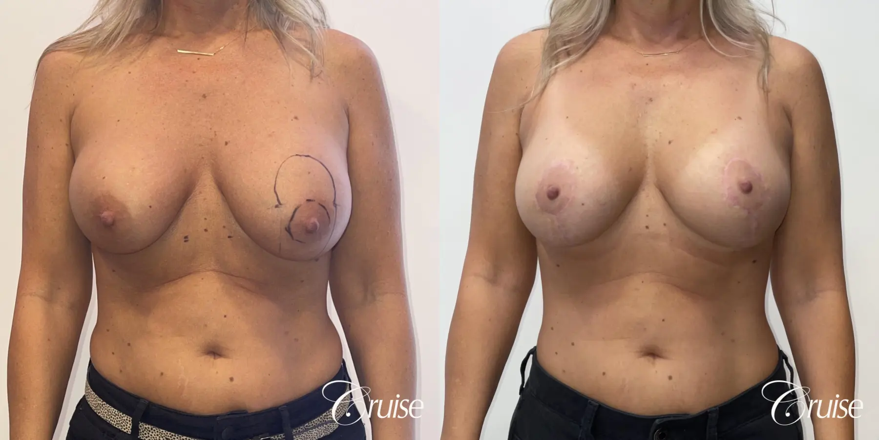 Breast Lift And Augmentation: Patient 78 - Before and After 1