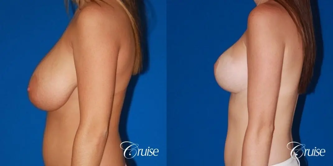 best breast lift and reduction with small saline implants - Before and After 2