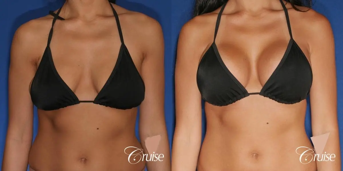 best breast lift anchor with silicone augmentation in Orange County - Before and After 4