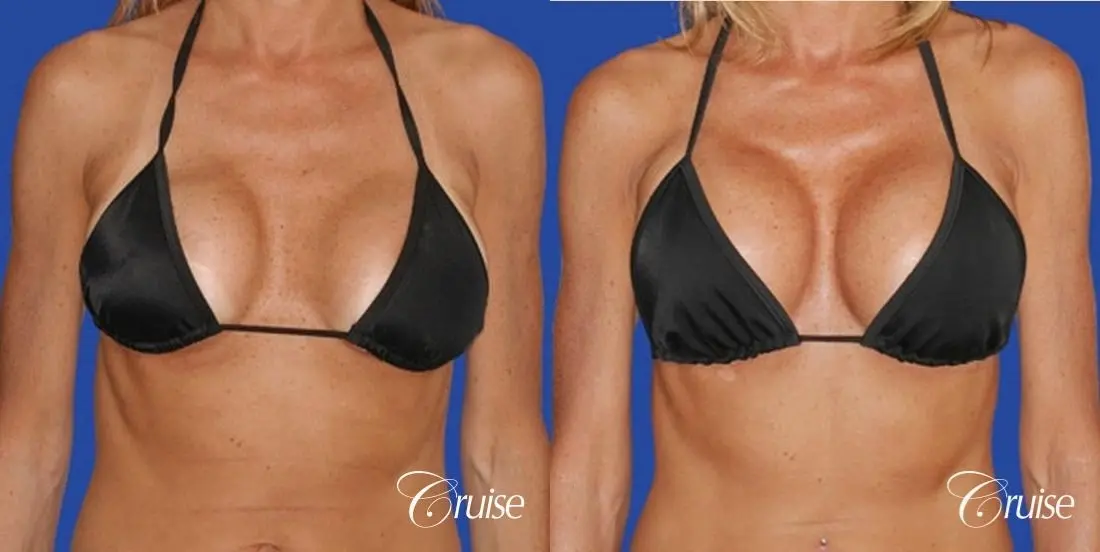 breast lift on one side only before and after pictures - Before and After 4