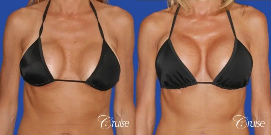 breast lift on one side only before and after pictures - Before and After 4