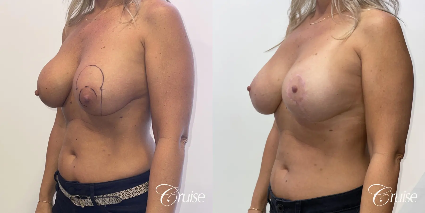 Breast Lift And Augmentation: Patient 78 - Before and After 3