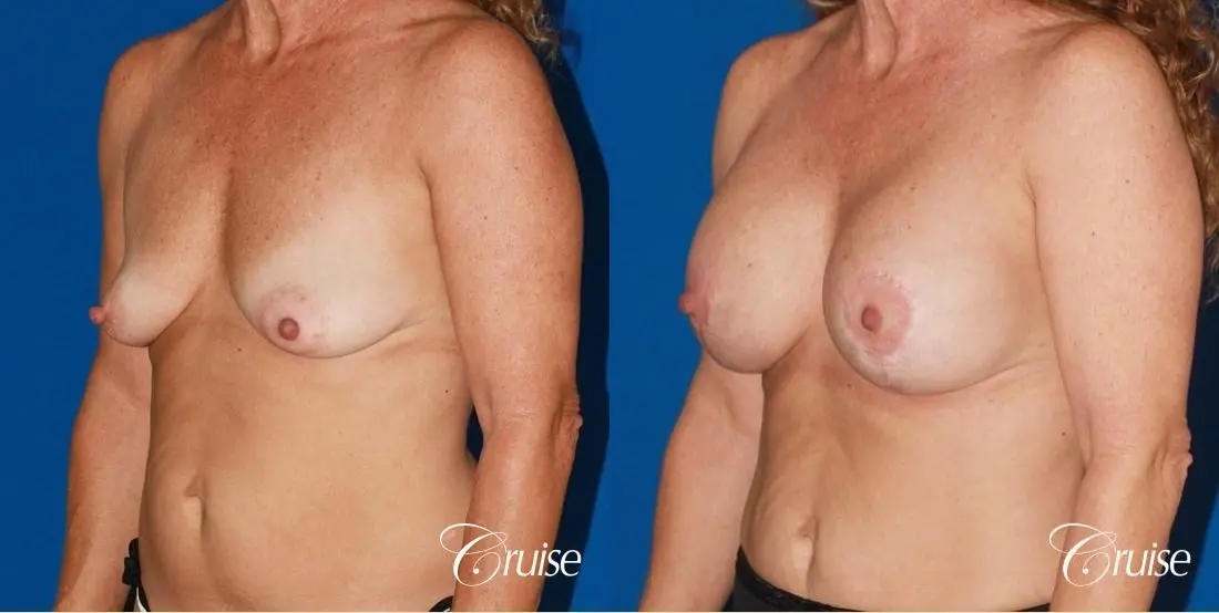 best high profile silicone breast lift 425cc - Before and After 3