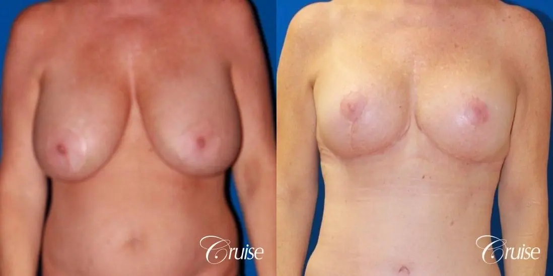 best breast lift revision with saline 270cc - Before and After 1