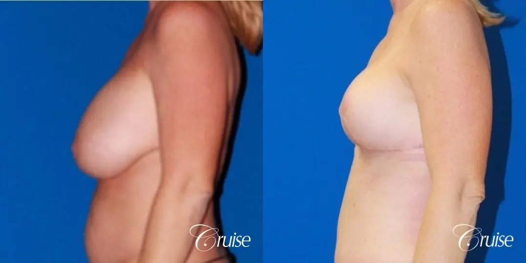 best breast lift revision with saline 270cc - Before and After 2