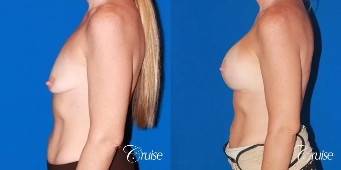 moderate profile saline breast lift anchor before and after pictures - Before and After 2