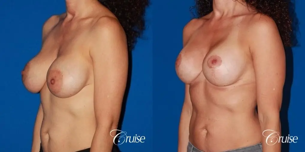 best breast lift revision with high profile silicone 425cc - Before and After 3