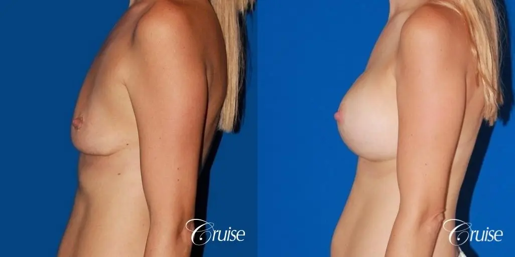 best breast lift anchor with High profile silicone 500cc implants - Before and After 2