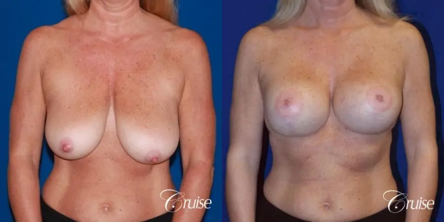 best breast lift with implants - Before and After