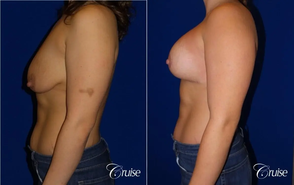 Breast Lift - Anchor w/ Saline Implants on Young Woman - Before and After 3