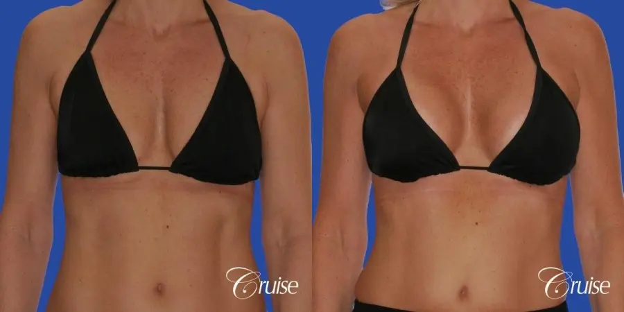 breast lift anchor with silicone implants on adult - Before and After 4