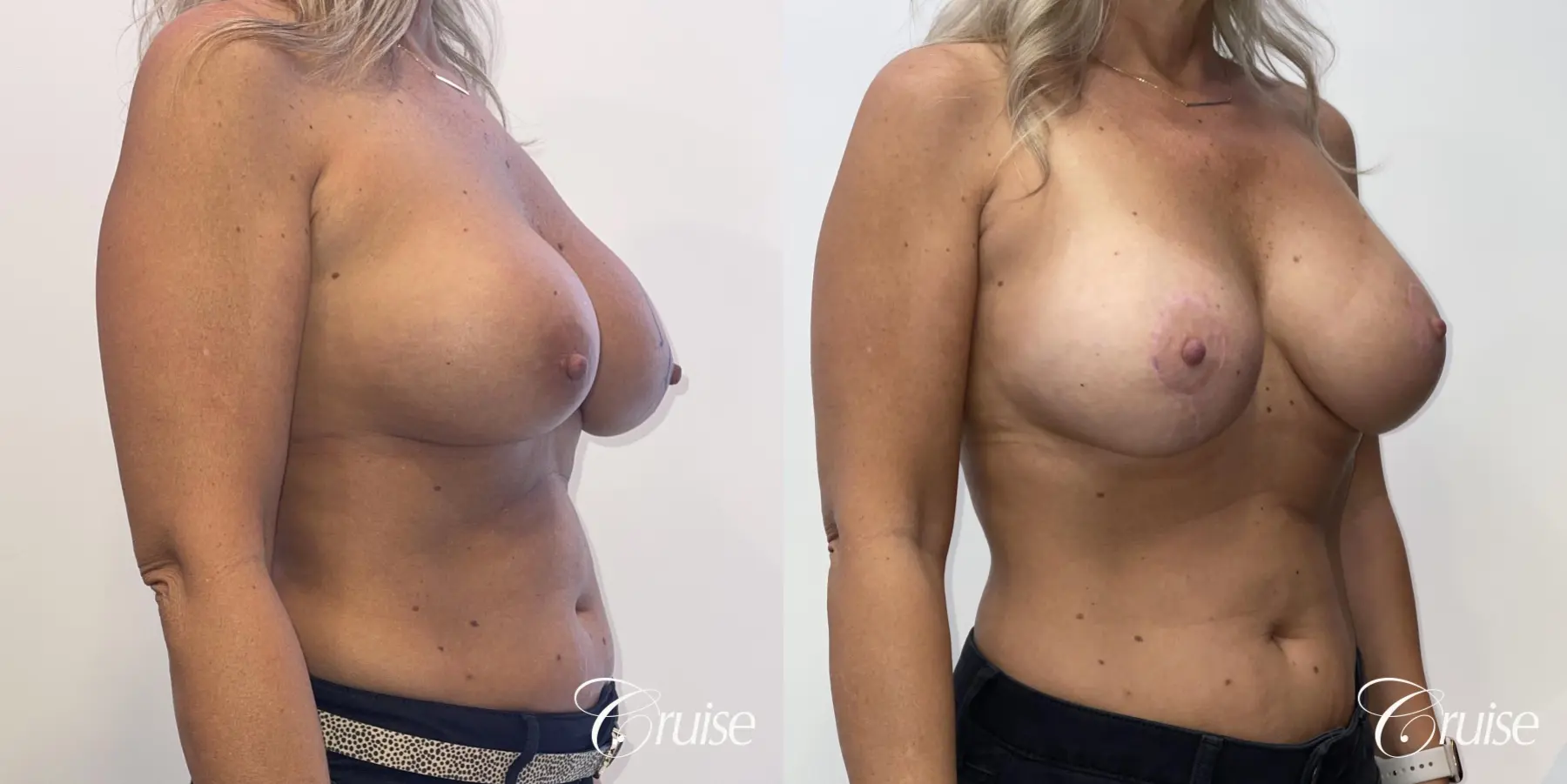 Breast Lift: Patient 1 - Before and After 2