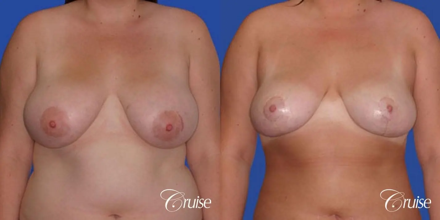 best breast reduction lift without implants newport beach - Before and After 1