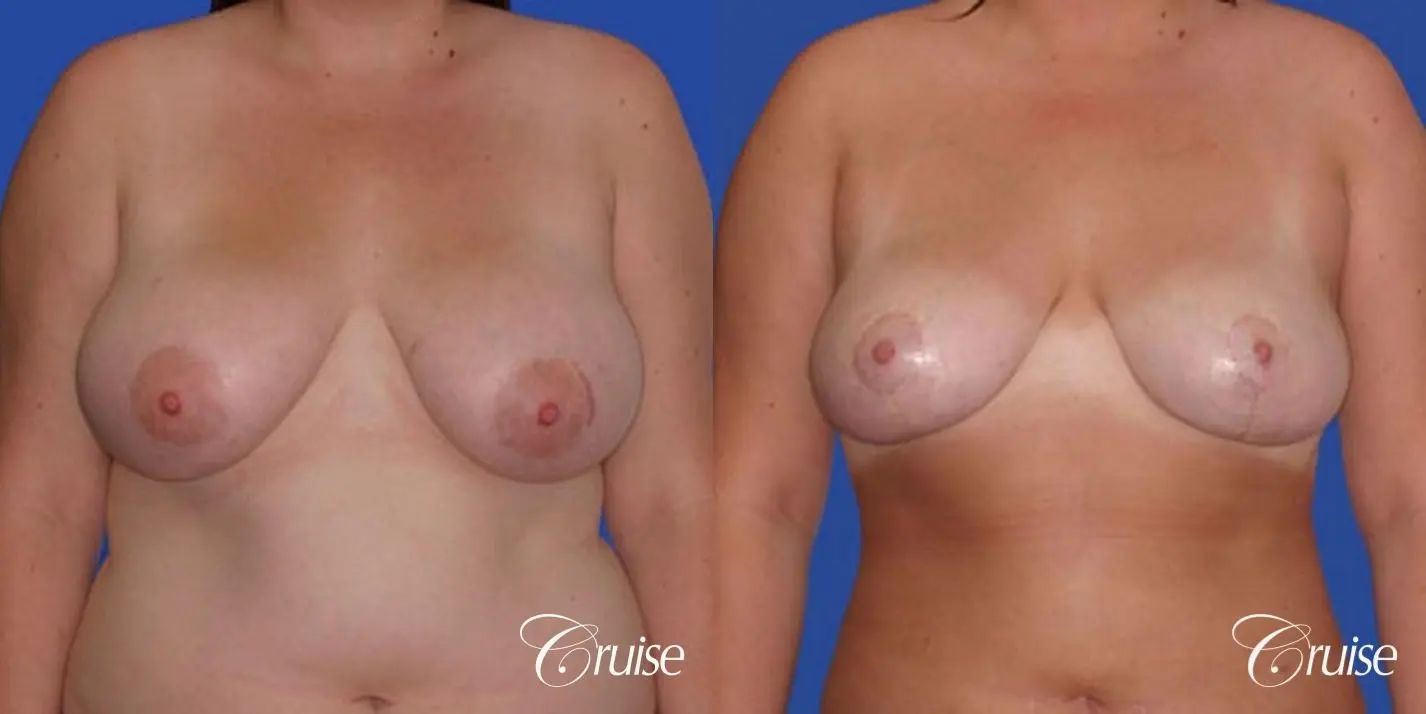 best breast reduction lift without implants newport beach - Before and After