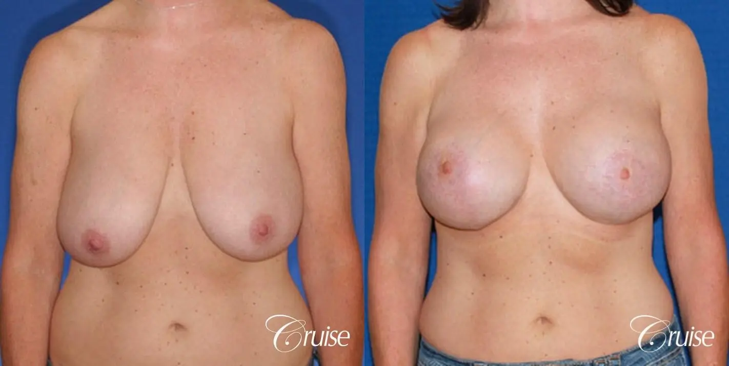 best breast reduction surgery with saline implants - Before and After 1