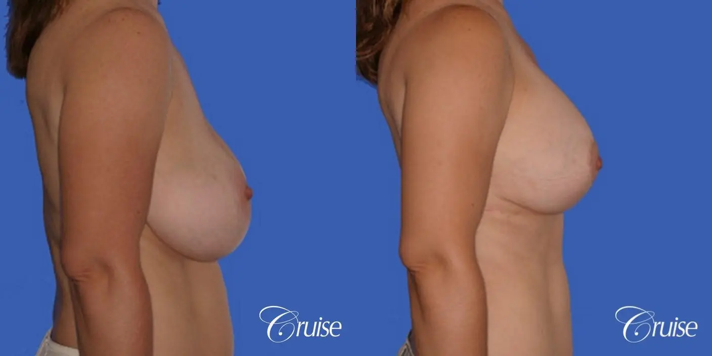best saline breast reduction - Before and After 2