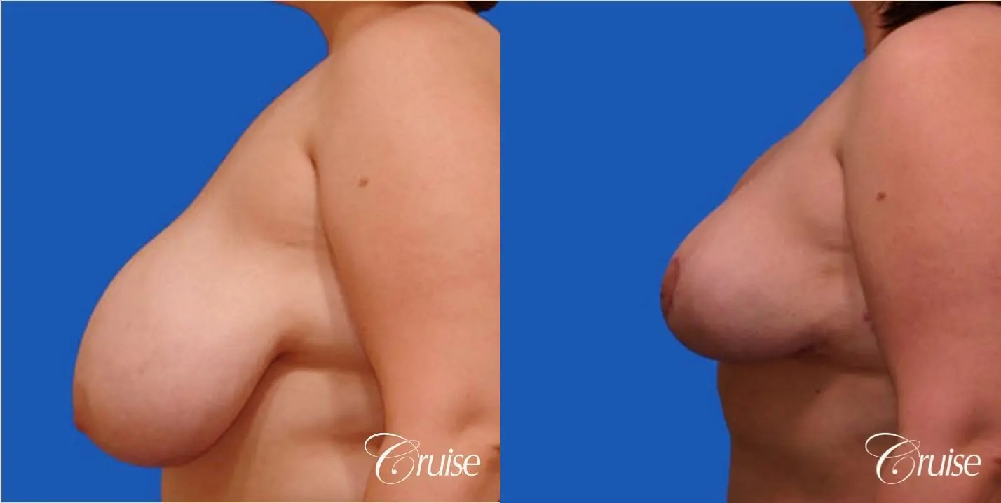 breast reduction surgery on large breast - Before and After 2