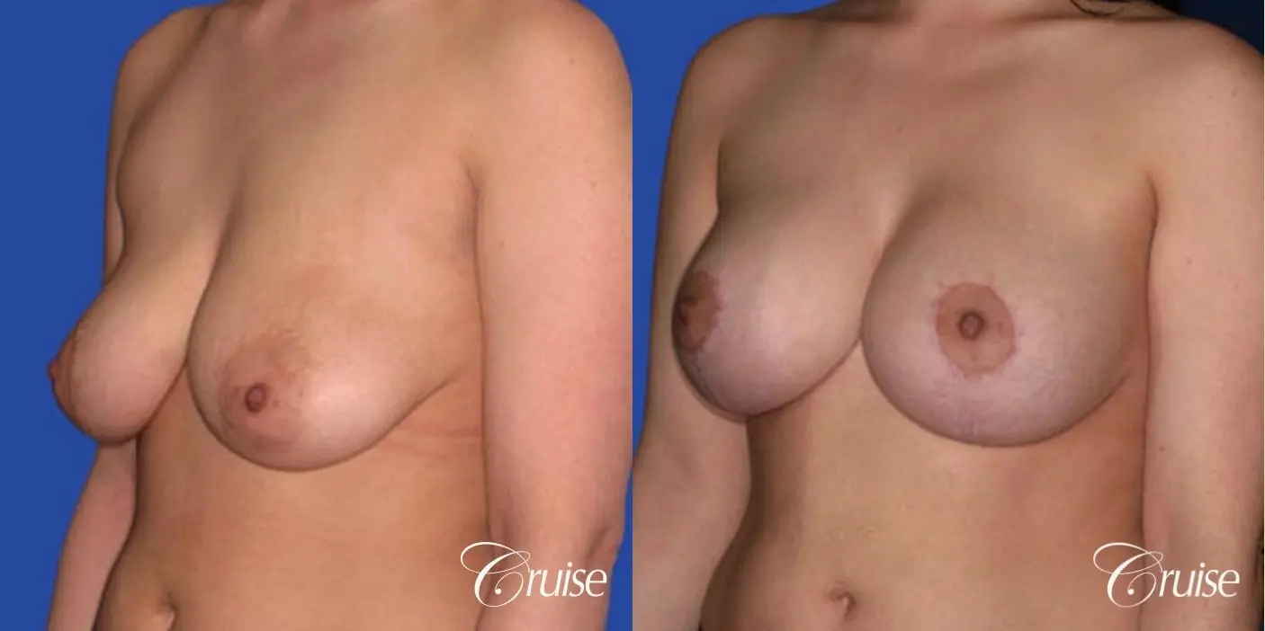 best round saline implants after breast reduction - Before and After 3