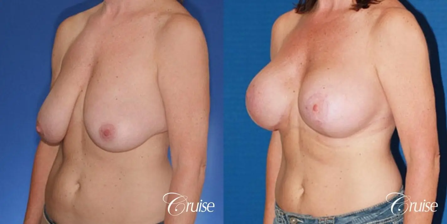 best breast reduction surgery with saline implants - Before and After 2