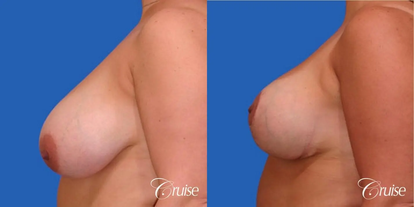 Best breast reduction with silicone augmentation - Before and After 2