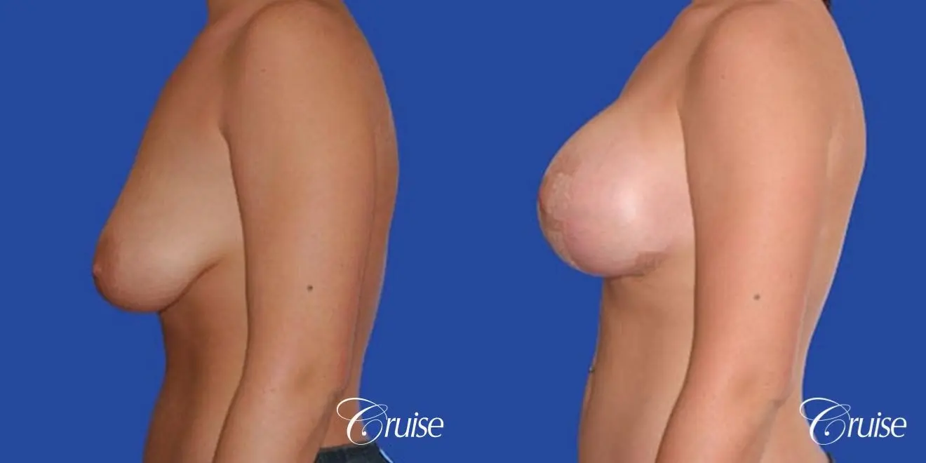 best photos of 20 yr old with saline breast reduction surgery - Before and After 2