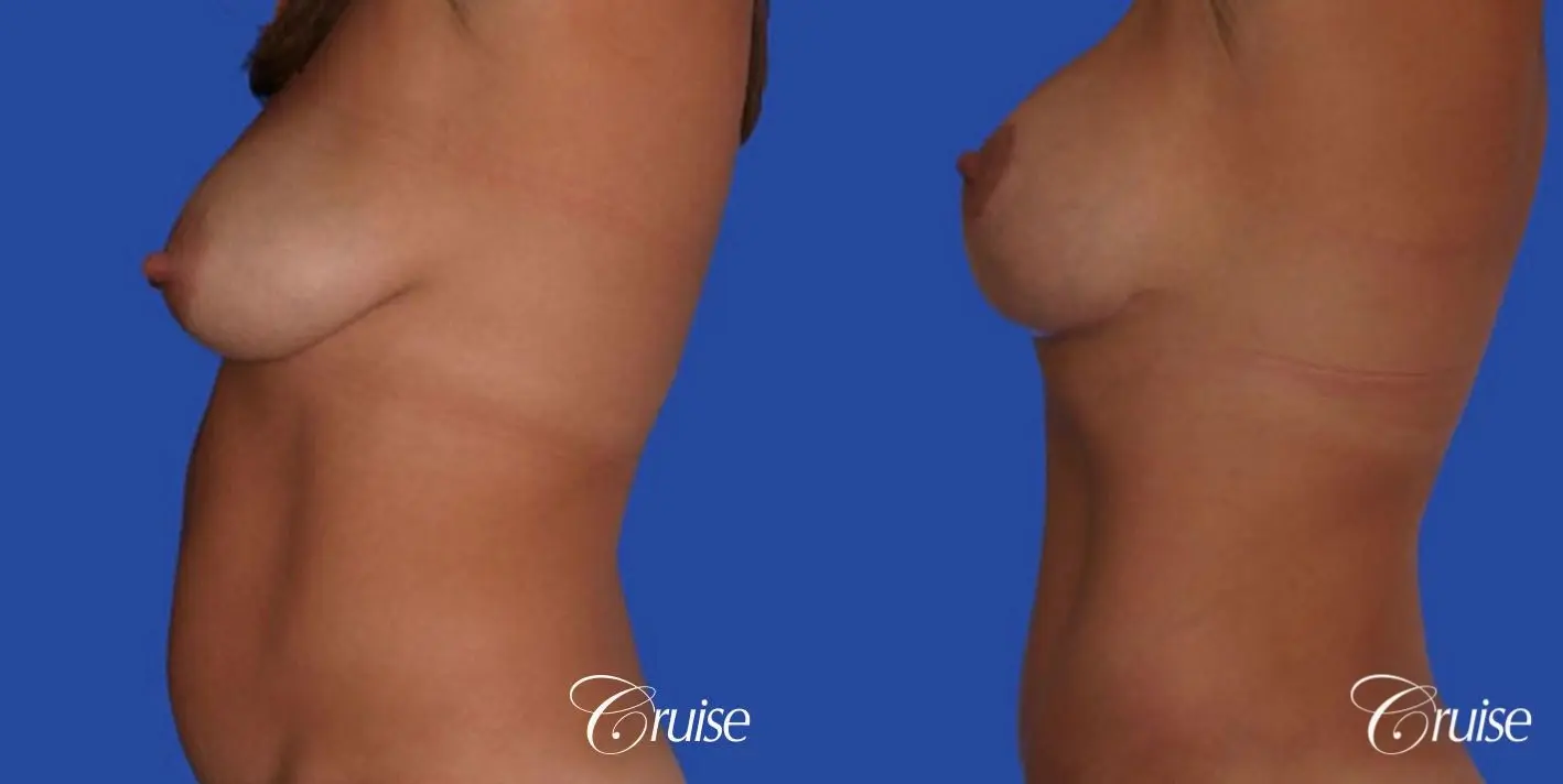 best silicone breast reduction surgery scars - Before and After 2