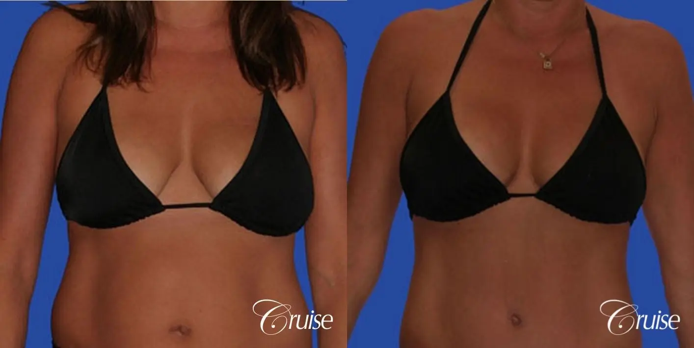 best silicone breast reduction surgery scars - Before and After 3