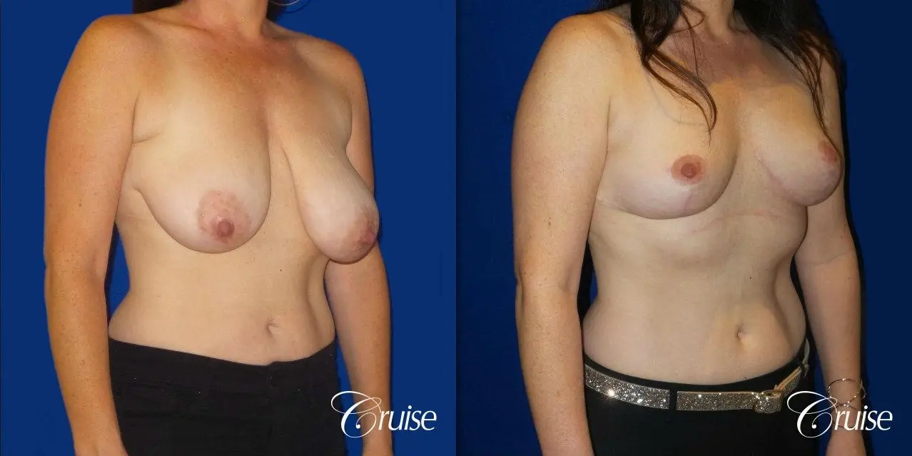 Breast Reduction No Implants - Before and After 4