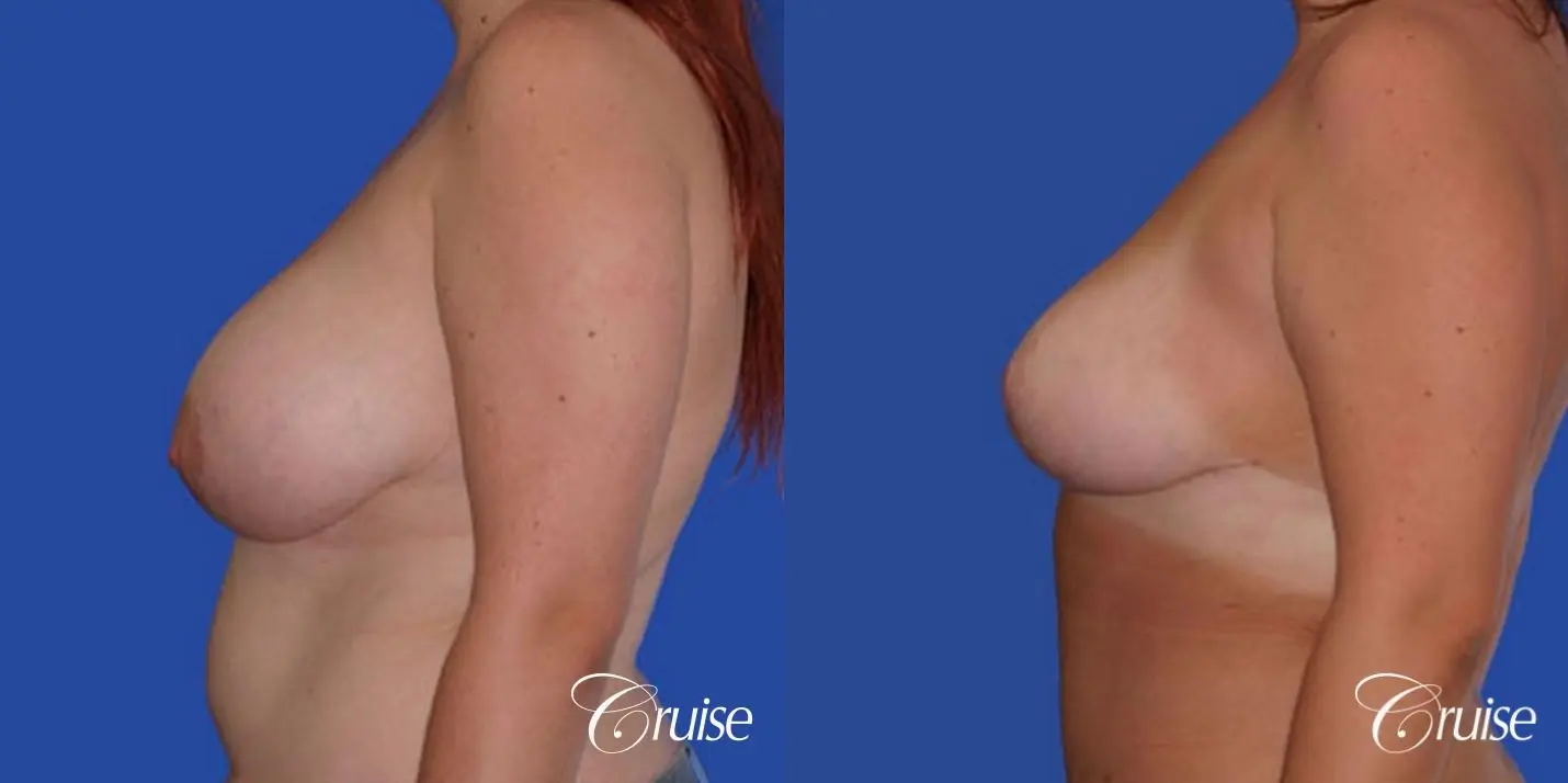 best breast reduction lift without implants newport beach - Before and After 2