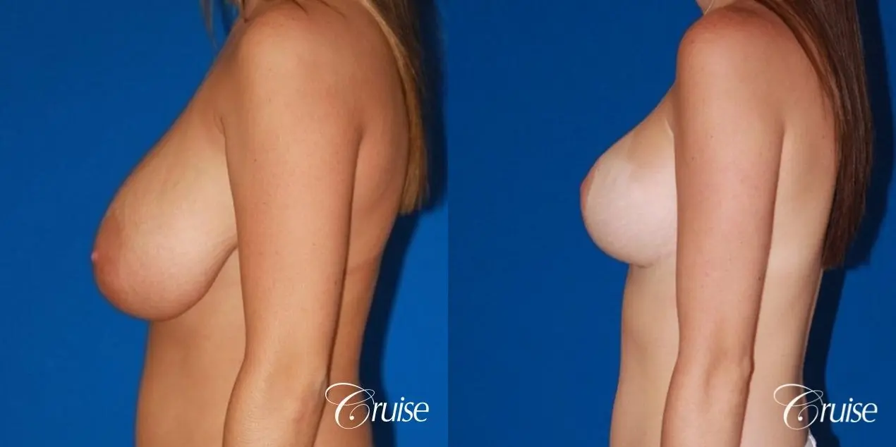 best saline breast reduction on large breast - Before and After 2