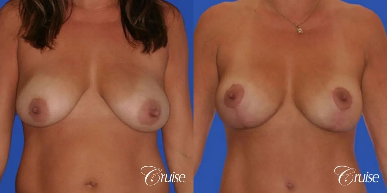 best silicone breast reduction surgery scars - Before and After 1