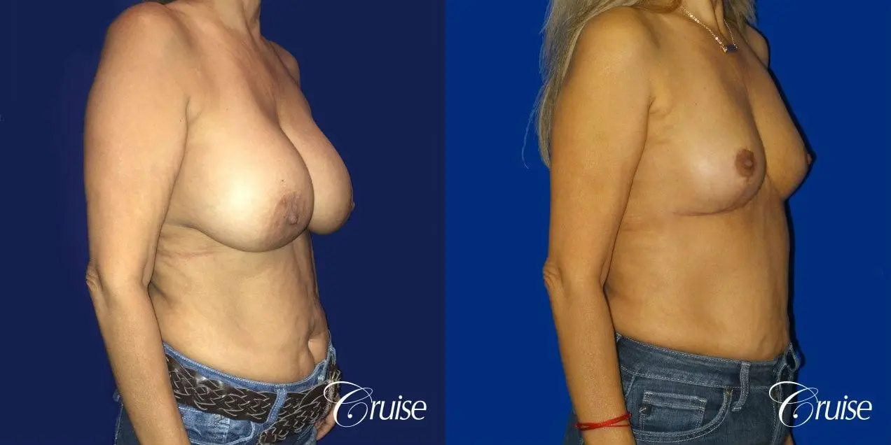 Best Breast reduction results and recovery - Before and After 5
