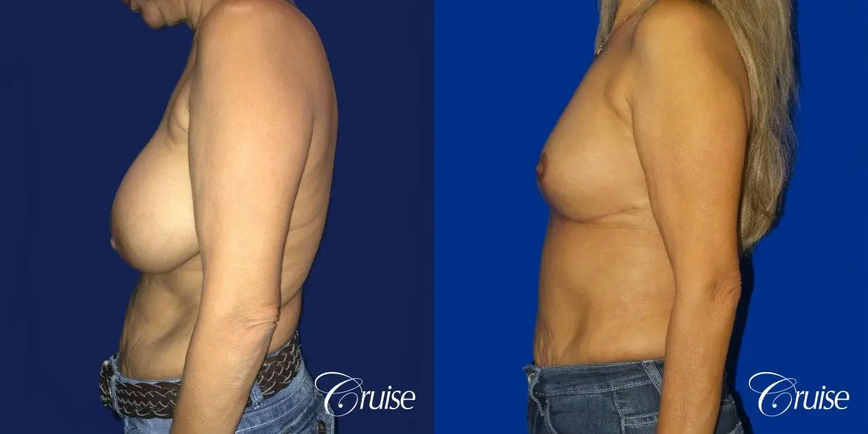 Best Breast reduction results and recovery - Before and After 2