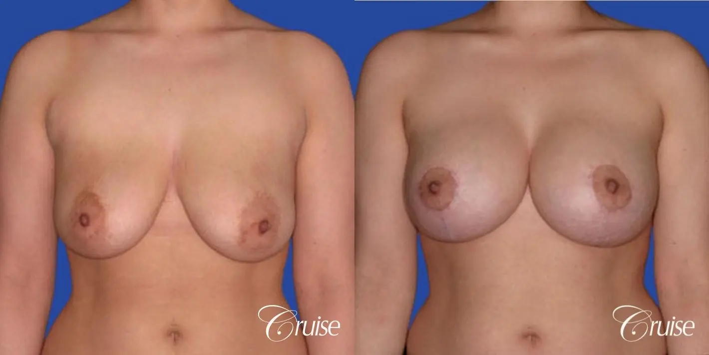 best round saline implants after breast reduction - Before and After 1