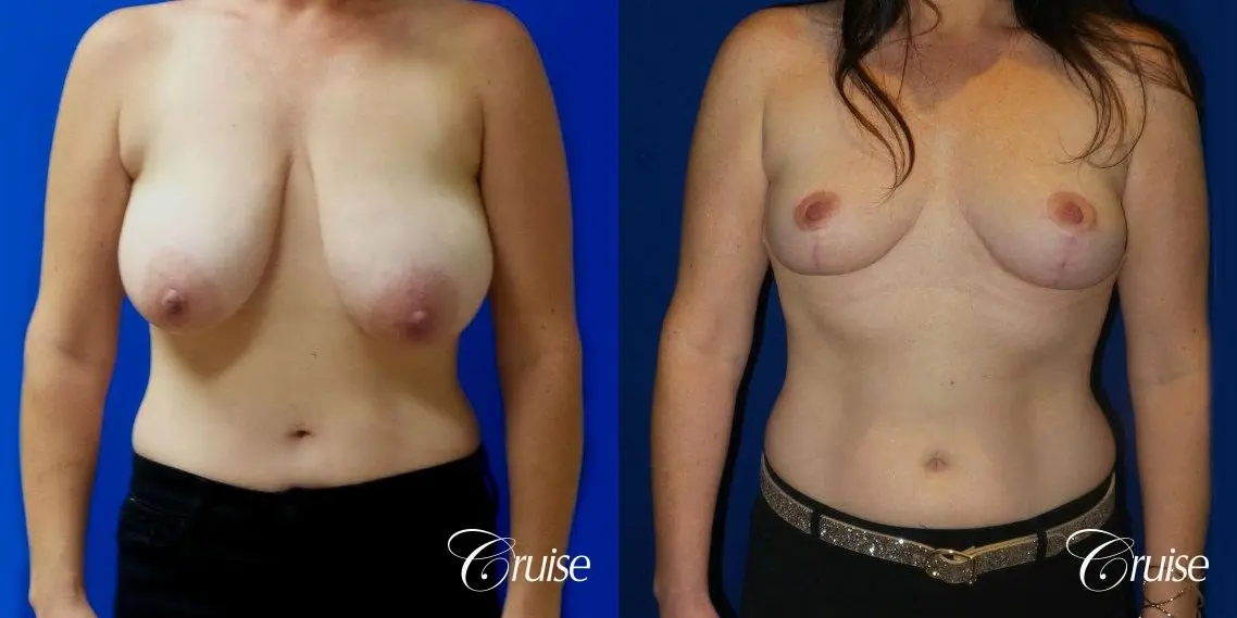 Breast Reduction No Implants - Before and After 1