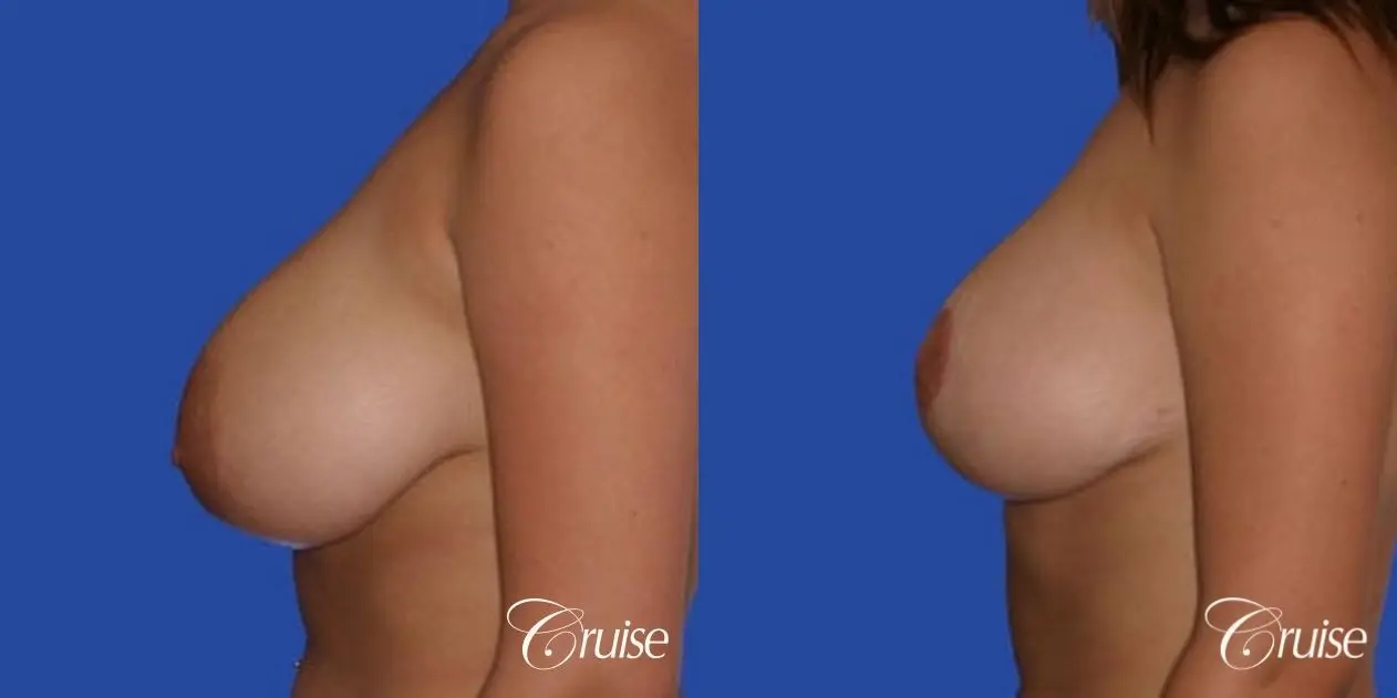 best 19 yr old breast reduction results - Before and After 2
