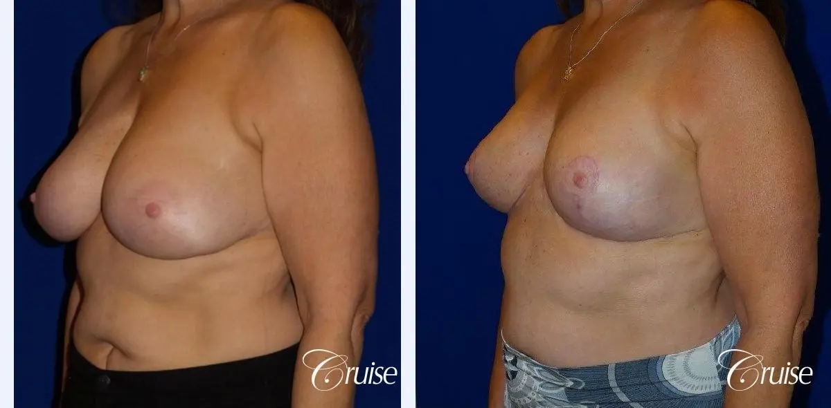Breast Reduction - No Implants - Before and After 3