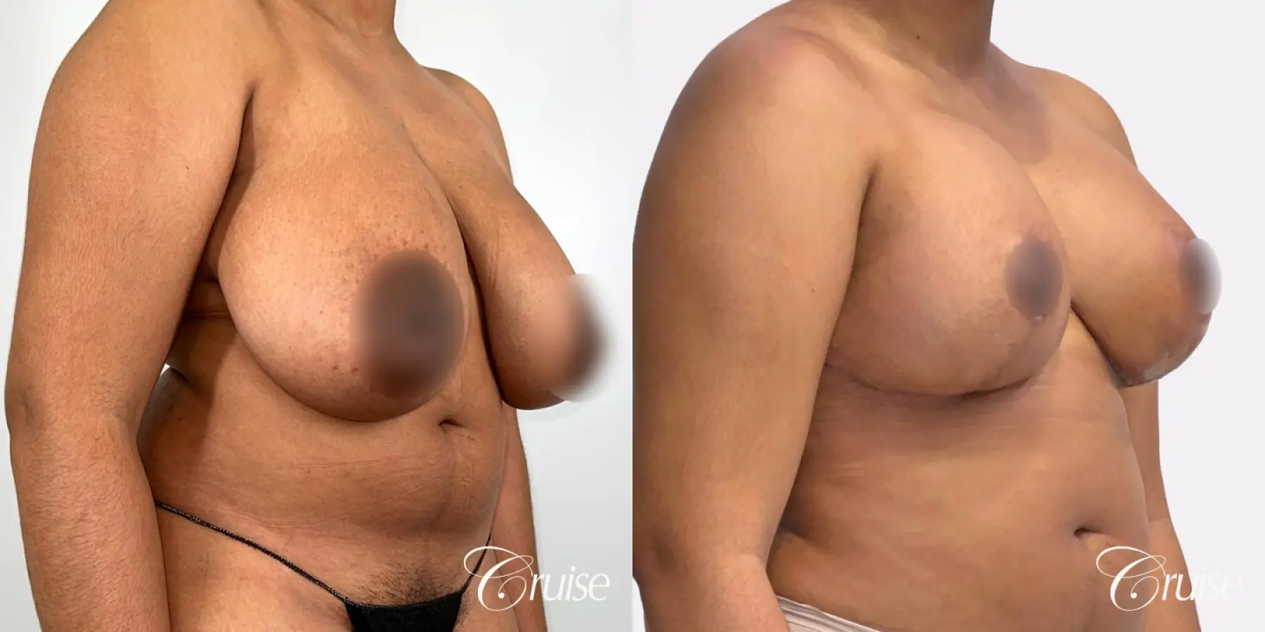 Breast Reduction & Breast Lift - Before and After 2