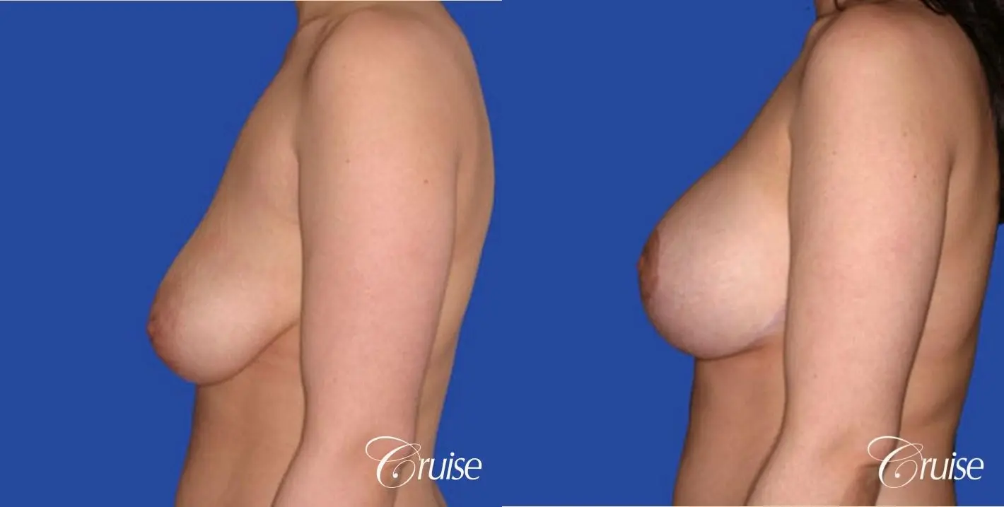 best round saline implants after breast reduction - Before and After 2