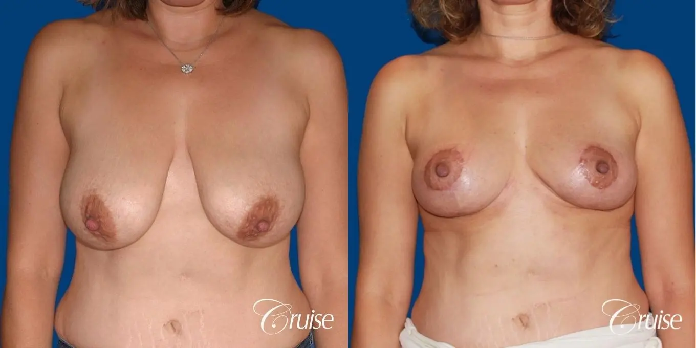 best breast reduction no implants - Before and After 1