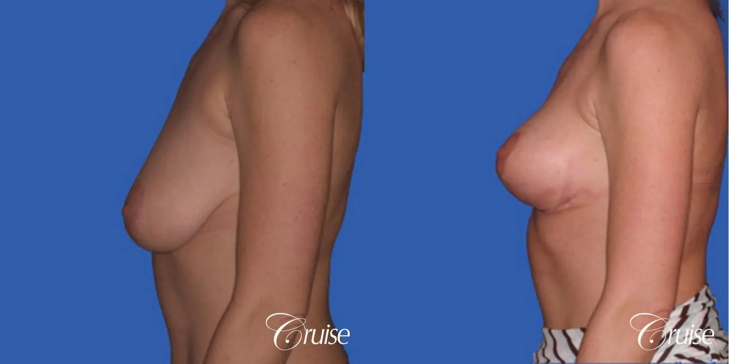 best breast reduction without implants - Before and After 2