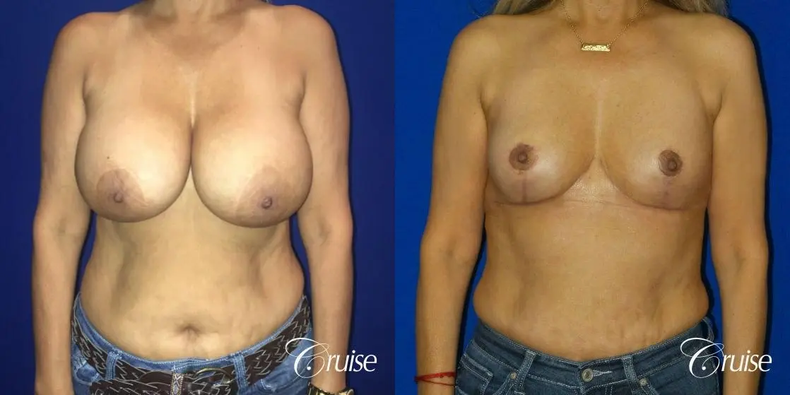 Best Breast reduction results and recovery - Before and After 1