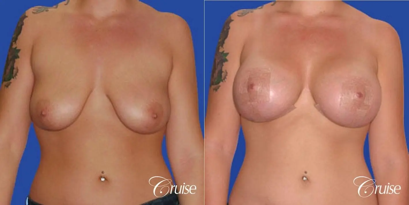 best photos of 20 yr old with saline breast reduction surgery - Before and After 1