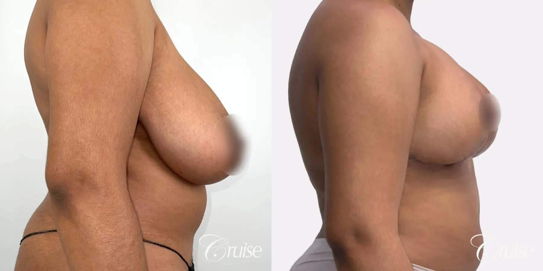 Breast Reduction & Breast Lift - Before and After 3