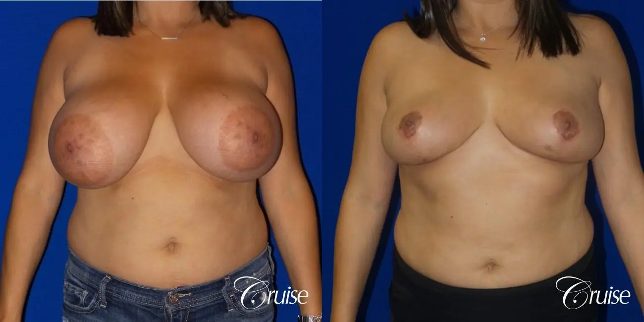 Breast reduction surgery with no implants added - Before and After 1