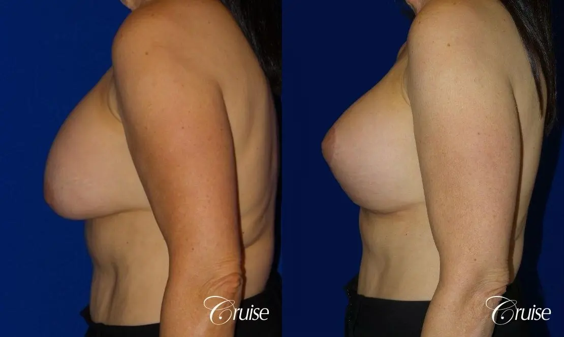 Breast Reduction - No Implants - Before and After 3