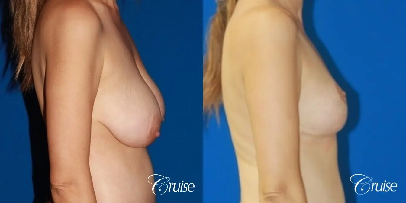 best reduction without implants in Newport Beach - Before and After 3